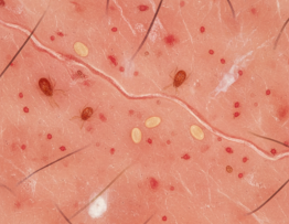 Image pour comment attraper la gale