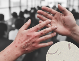 Image pour comment s attraper la gale