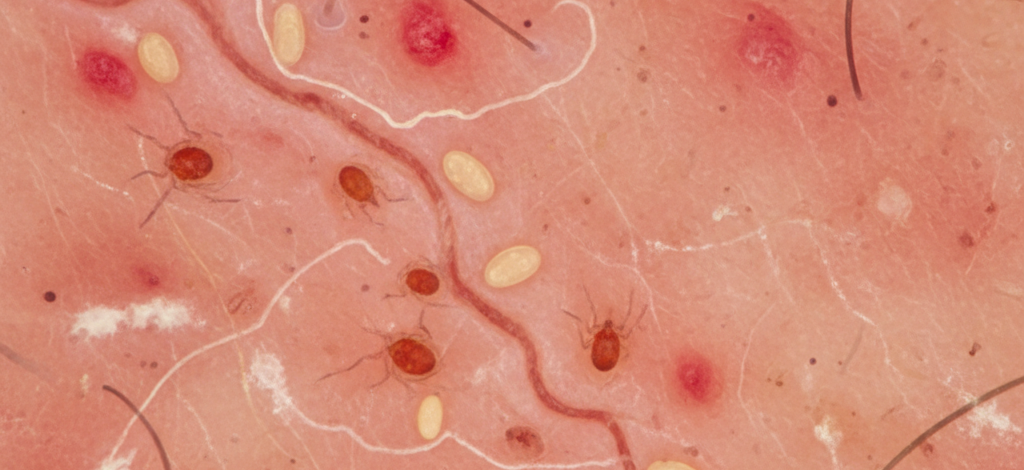 Image pour comment attraper la gale