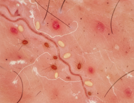 Image pour comment attraper la gale