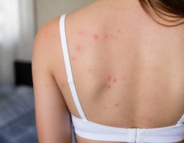 Boutons de punaises de lit photos : comment les reconnaître et les différencier des piqûres de rats et de souris