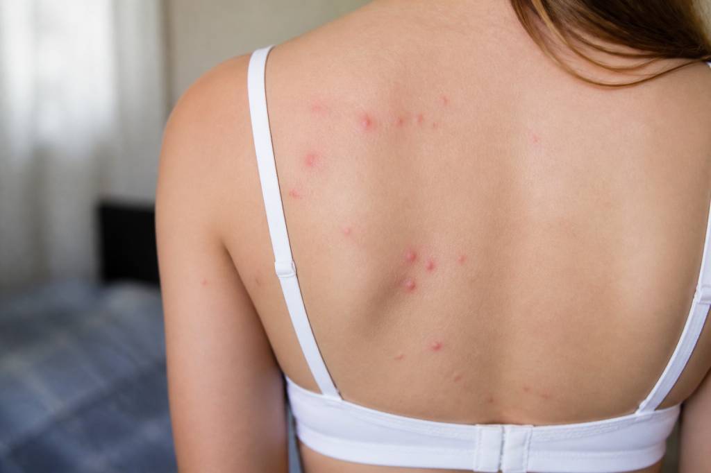 Boutons de punaises de lit photos : comment les reconnaître et les différencier des piqûres de rats et de souris