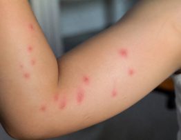 Boutons puce de lit photo : comment les reconnaître et les différencier des piqûres de rats et souris