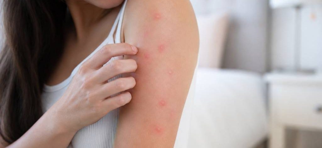 Allergies punaises de lit : comment les reconnaître et les soulager rapidement