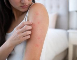 Allergies punaises de lit : comment les reconnaître et les soulager rapidement