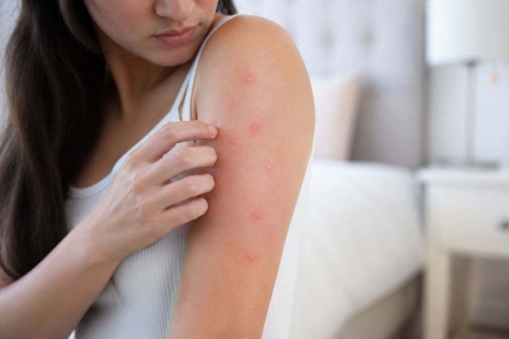Allergies punaises de lit : comment les reconnaître et les soulager rapidement