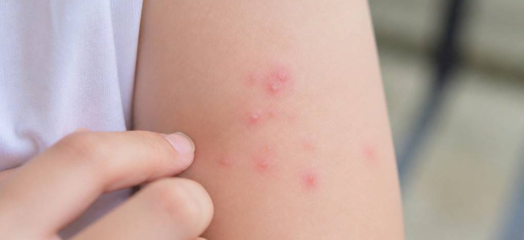 Acarien piqure : comment reconnaître et traiter les piqûres d’acariens