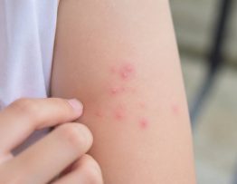 Acarien piqure : comment reconnaître et traiter les piqûres d’acariens